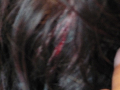 The back of my injured head.